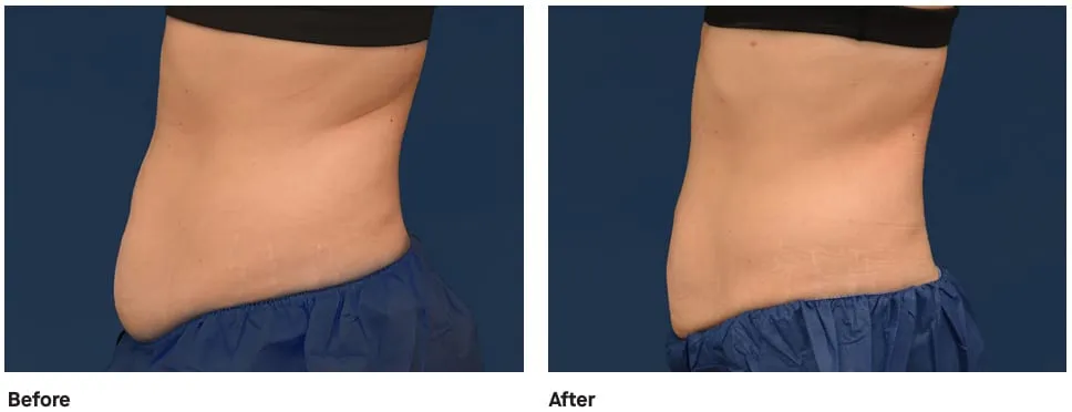 CoolSculpting® Elite NYC before and after