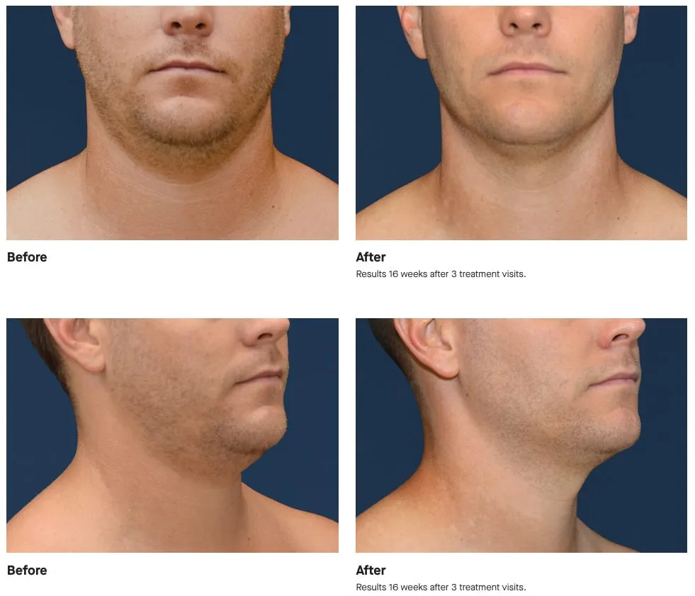 A man's chin and neck photographed before and after CoolSculpting Elite, from the front and in three-quarter profile, showing a reduced double chin and a defined jawline. Results 16 weeks after 3 treatment visits.