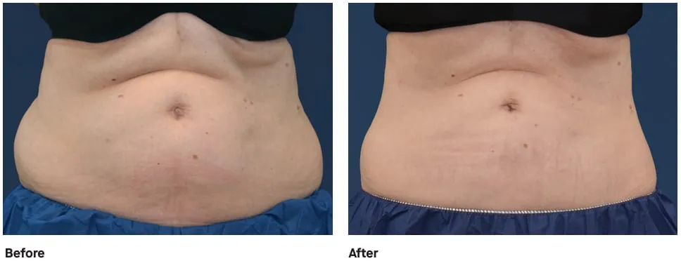 An abdomen photographed from the front before and after CoolSculpting Elite, showing a flatter waistline.