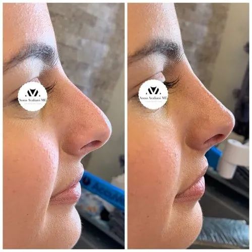 A non-surgical nose job performed by Dr. Avaliani, before and after