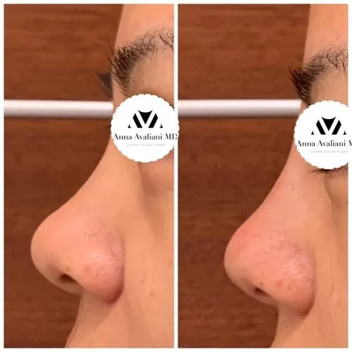 A non-surgical nose job performed by Dr. Avaliani, before and after