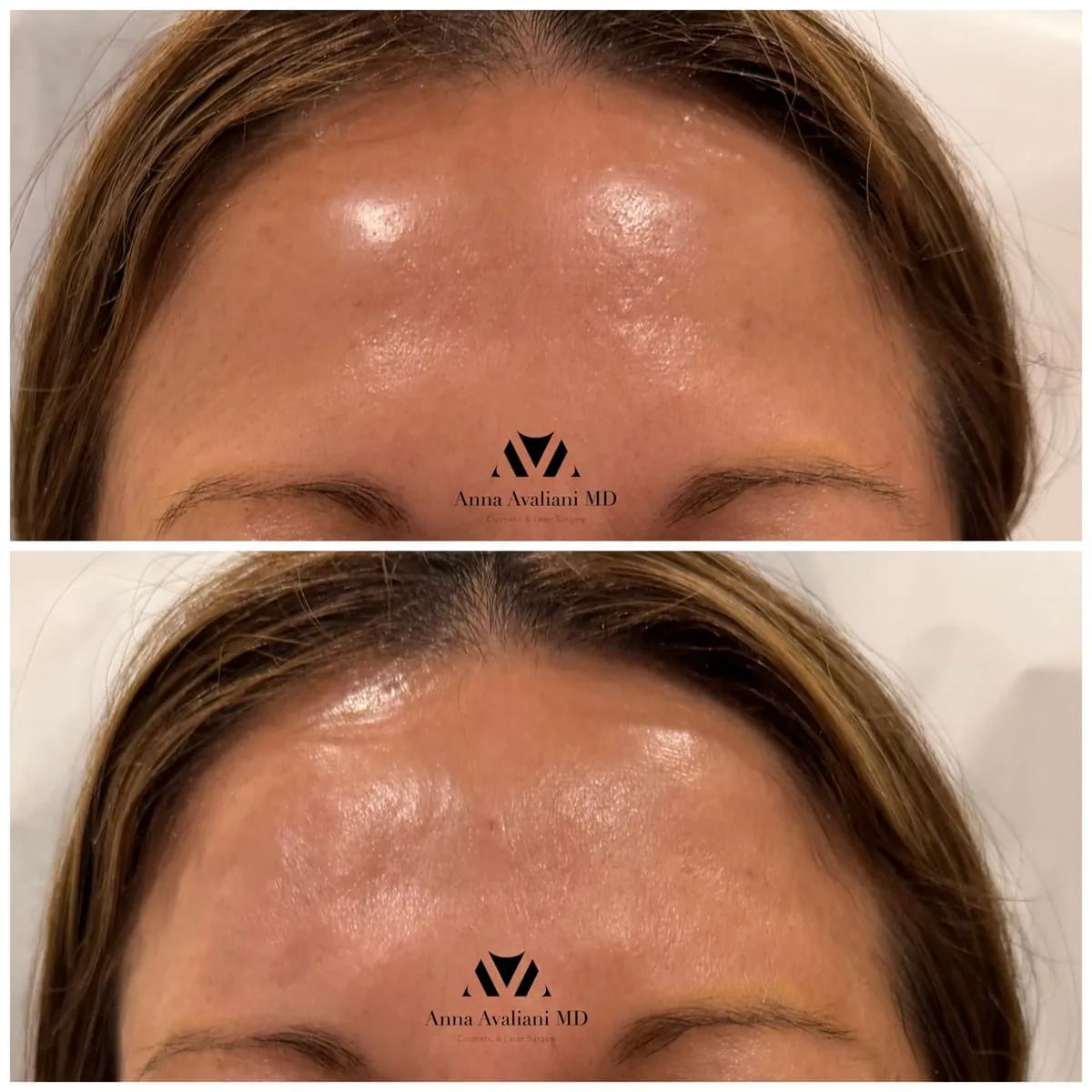 Female forehead filler before and after by Dr. Anna Avaliani in New York City showing restoration of smooth forehead contour