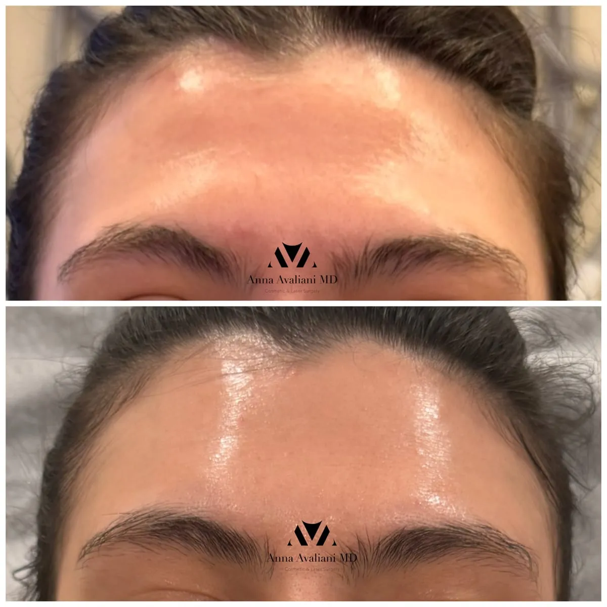 Forehead filler for women before and after by Dr. Anna Avaliani showing a smoother upper facial contour and improved balance