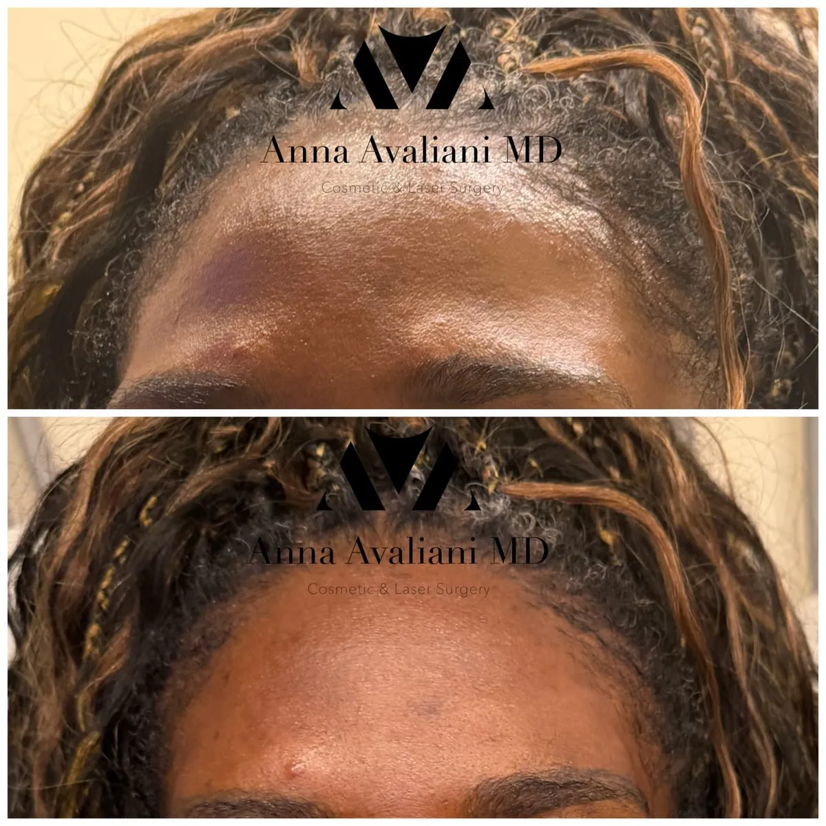 Female forehead rejuvenation before and after by Dr. Anna Avaliani showing subtle volume restoration and improved forehead shape