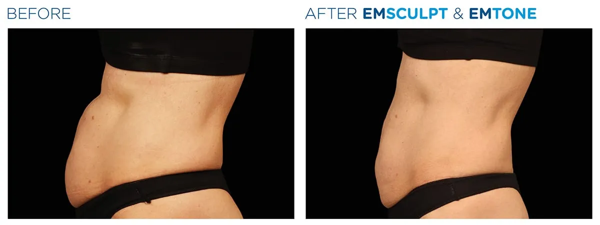 EMSCULPT® in NYC before and after