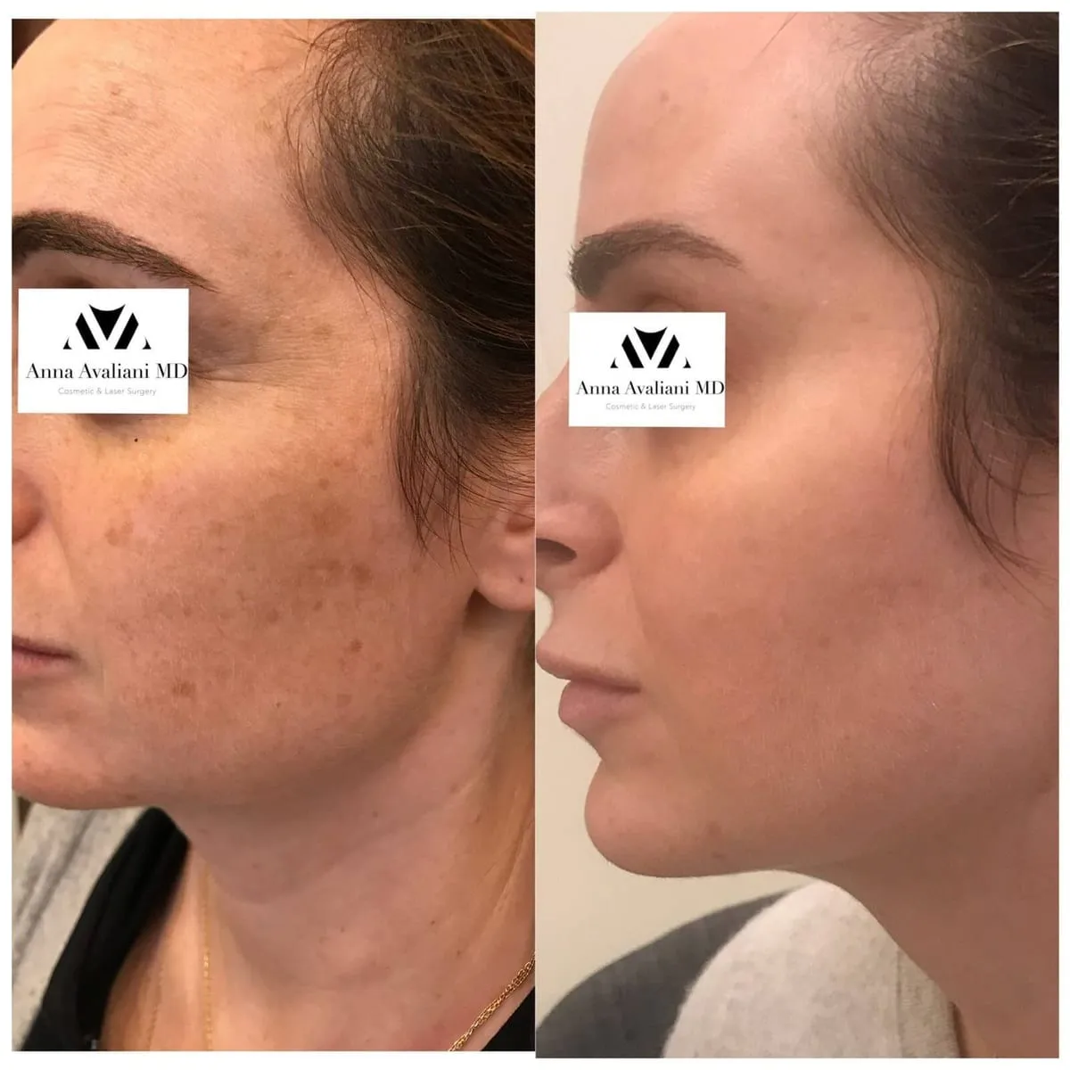 PicoSure: The Dark Spot Removal Treatment For All Skin Types