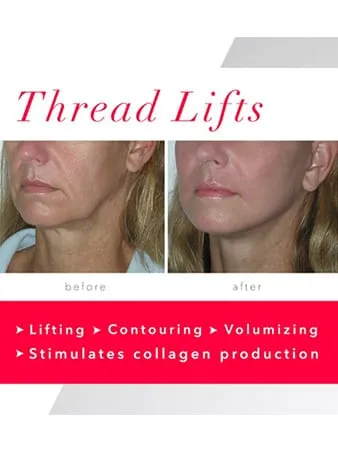 Non Surgical Lunch Time Thread Face Lift