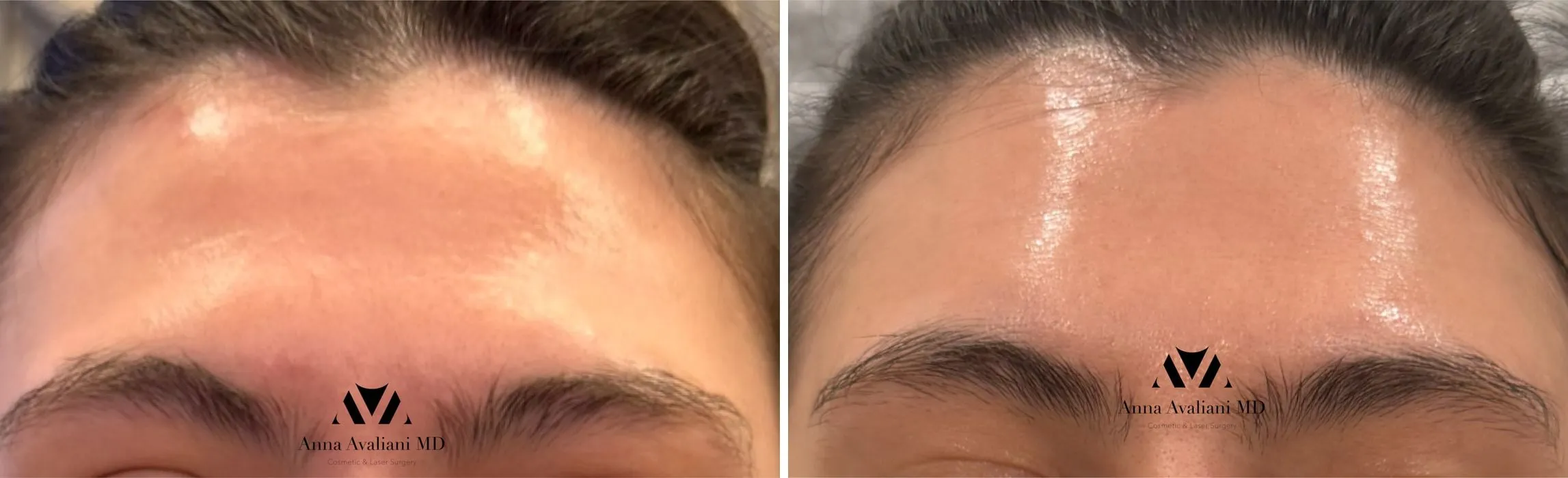 Non-Surgical Forehead Filler before and after