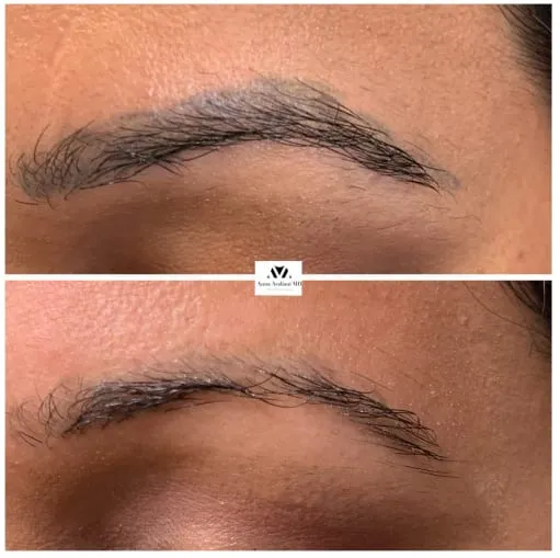 PicoSure Skin Glow Treatment: Remove sun spots and renew the skin with no downtime