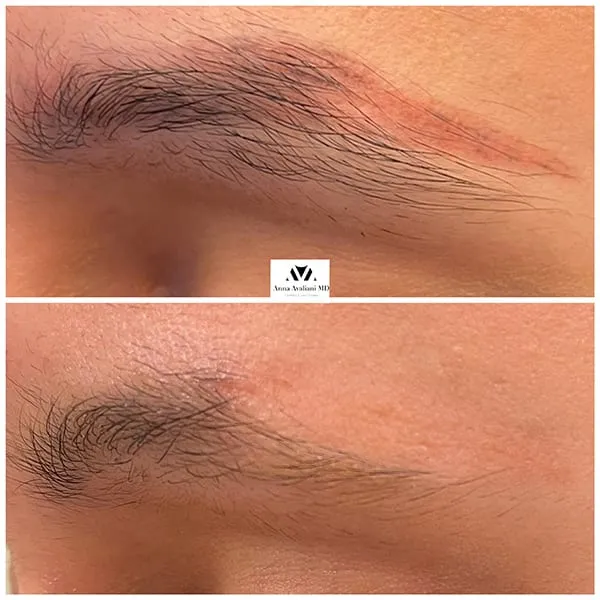 PicoSure® Tattoo NYC before and after