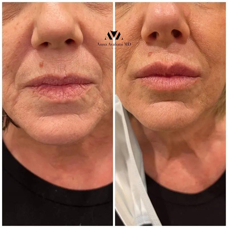 Don’t settle for dry raisin lips