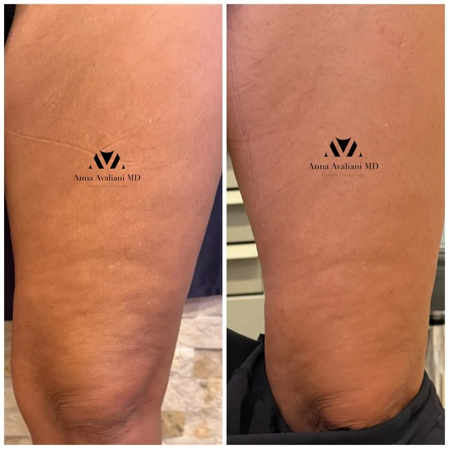 Sculptra® Body before and after
