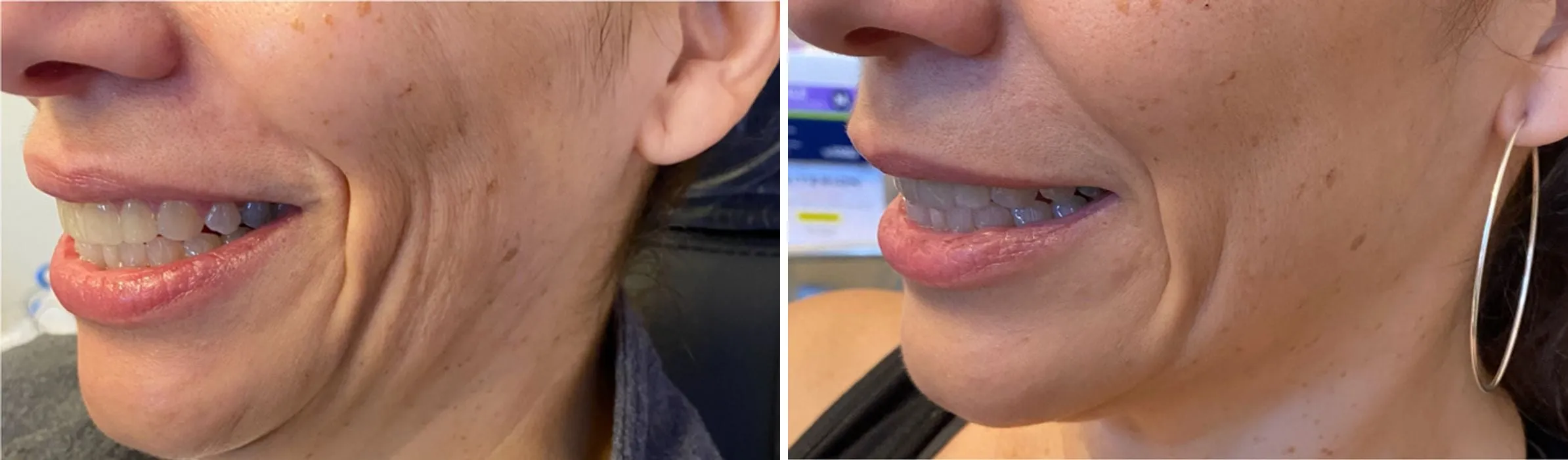Sculptra® Face before and after