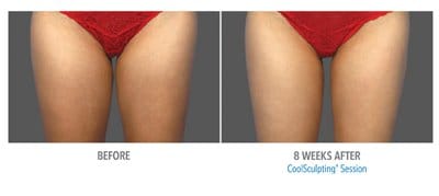 CoolSculpting before and after, result 1