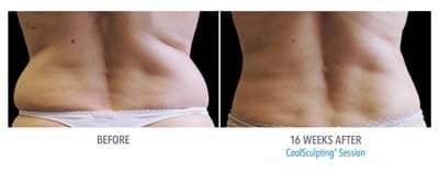 CoolSculpting before and after, result 10
