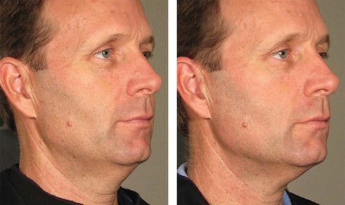 Ulthera before and after, result 9