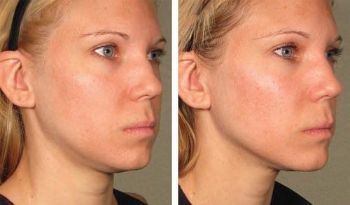 Ulthera before and after, result 10