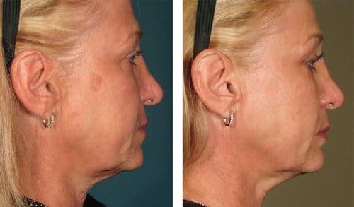 Ulthera before and after, result 11