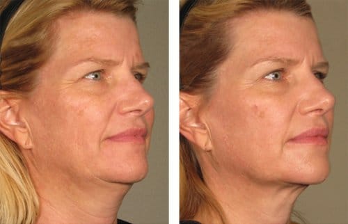 Ulthera before and after, result 6