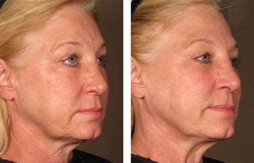 Ulthera before and after, result 7