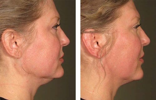 Ulthera before and after, result 5