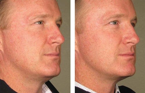 Ulthera before and after, result 8