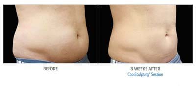 CoolSculpting before and after, result 2
