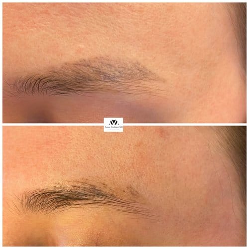 Tattoo Eyebrow Removal before and after, result 3