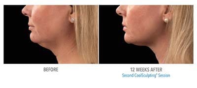 CoolSculpting before and after, result 3