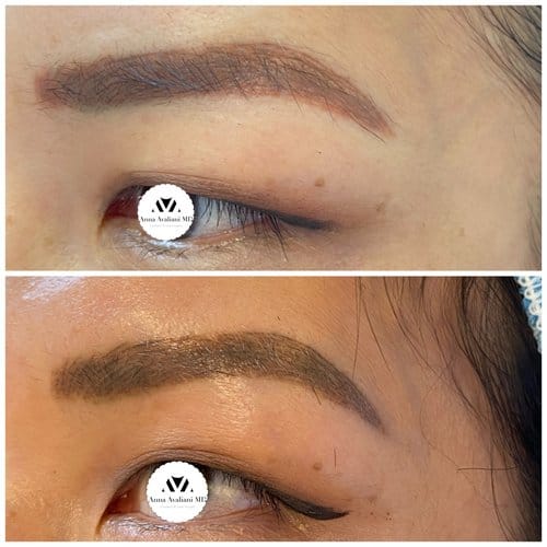 Tattoo Eyebrow Removal before and after, result 6