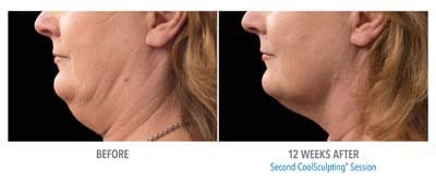 CoolSculpting before and after, result 4