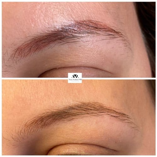Tattoo Eyebrow Removal before and after, result 5