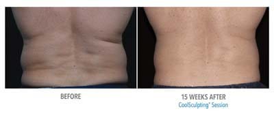 CoolSculpting before and after, result 5