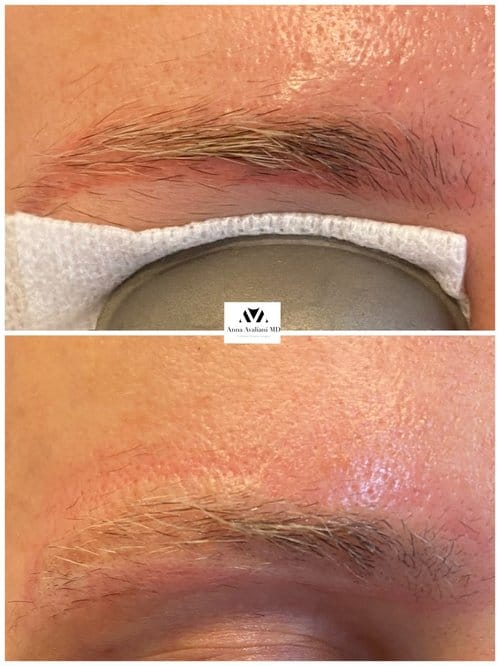 Tattoo Eyebrow Removal before and after, result 2