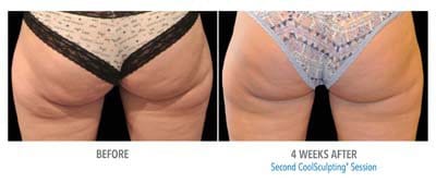 CoolSculpting before and after, result 6