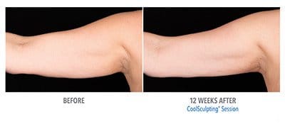 CoolSculpting before and after, result 7