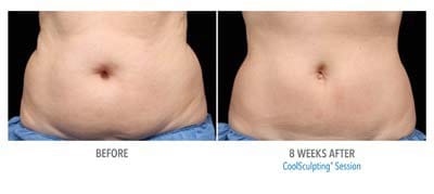 CoolSculpting before and after, result 8