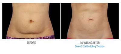 CoolSculpting before and after, result 9