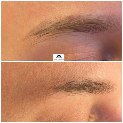 Tattoo Eyebrow Removal before and after, result 1