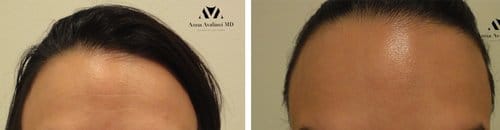 Botox before and after, result 89
