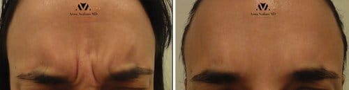Botox before and after, result 96