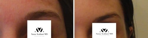 Botox before and after, result 97