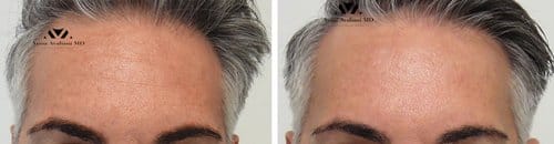 Botox before and after, result 90