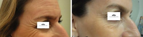 Botox before and after, result 91