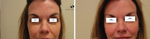 Botox before and after, result 92