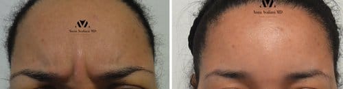 Botox before and after, result 93
