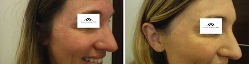 Botox before and after, result 95
