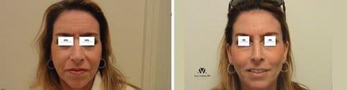 Botox before and after, result 94