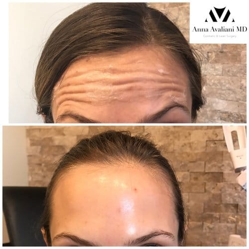 Botox before and after, result 73