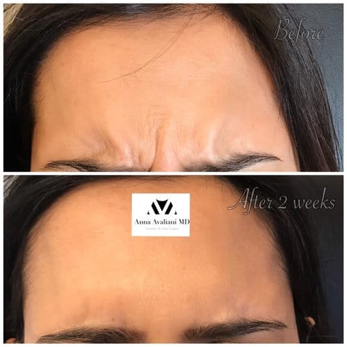 Botox before and after, result 82